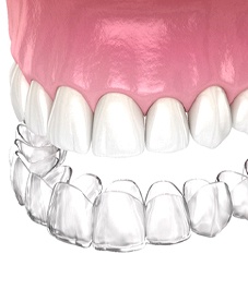 A digital image of an Invisalign aligner preparing to go on over a top row of teeth
