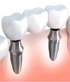 A diagram of an implant-retained bridge