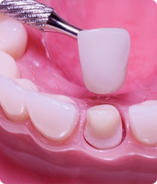 dental crowns