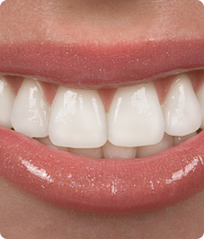 porcelain veneers