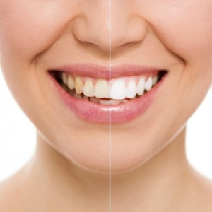 Teeth whitening trays are customized to fit perfectly