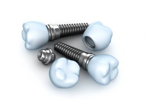 Your dentist for dental implants in Horsham.