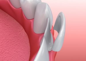 model of teeth showing porcelain veneers