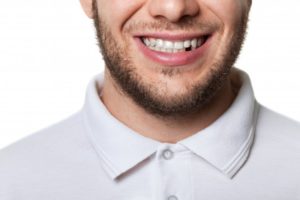 man smiling missing tooth