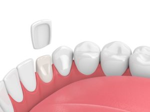 porcelain veneers