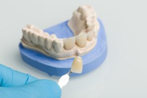dentist putting veneers on molds of teeth