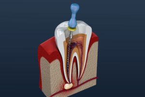 Image of dentist in Philadelphia performing root canal.